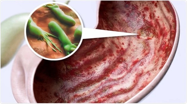 Nguyên nhân gây loét dạ dày tá tràng