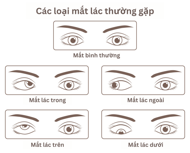 mắt bị lác nhẹ