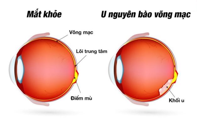 dấu hiệu u nguyên bào võng mạc
