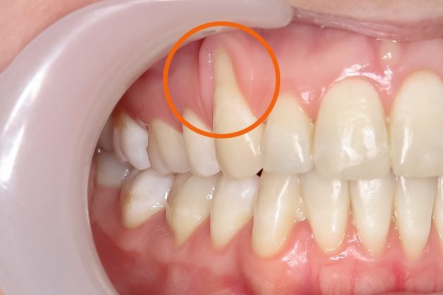 Tụt lợi hàm trên dễ phát hiện hơn tụt lợi hàm dưới