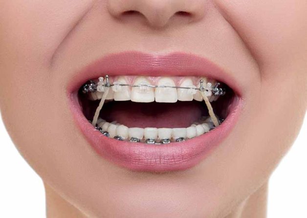 Chỉnh nha sai kỹ thuật có thể làm lợi bị tụt