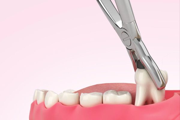 Kìm tác động lực làm gãy chân răng và lấy răng ra khỏi ổ xương hàm