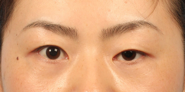 sụp mi mắt