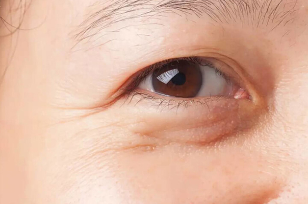 sụp mi mắt