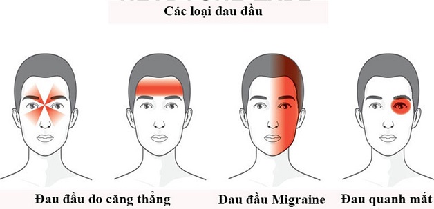 Tại sao đau đầu? Có phải đau đầu do căng thẳng?