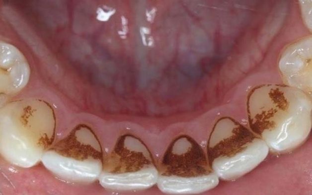 Cao răng huyết thanh là cao răng thường thấm đẫm máu và huyết thanh