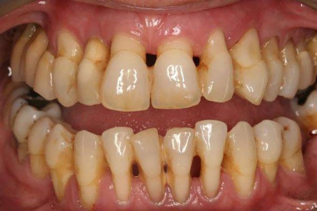 Tại sao lấy cao răng lại bị chảy máu? Viêm nha chu là nguyên nhân gây chảy máu khi lấy cao răng
