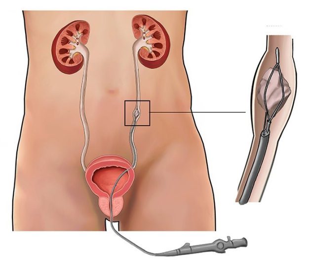 Tán sỏi thông qua nội soi niệu đạo có gây đau không?