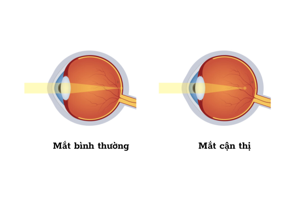 Hình ảnh và ánh sáng thu vào mắt, hội tụ ở trước võng mạc thay vì đúng trên võng mạc được gọi là cận thị
