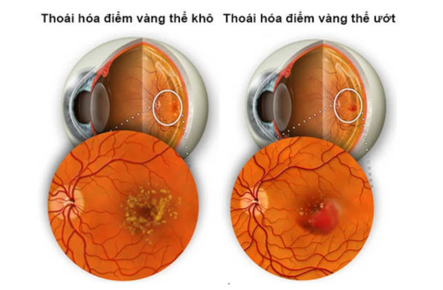 thoái hóa hoàng điểm mắt