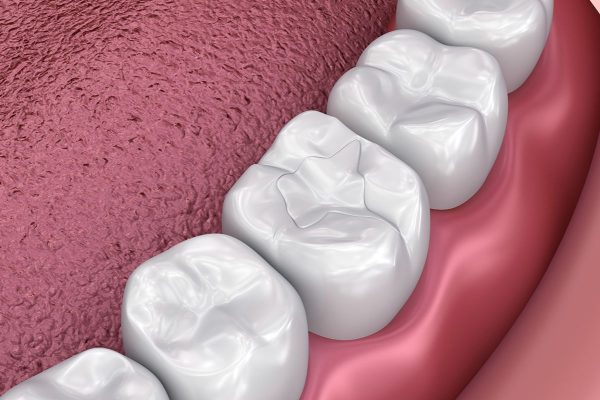 Trám răng bằng composite phục hình cả chức năng lẫn thẩm mỹ của răng