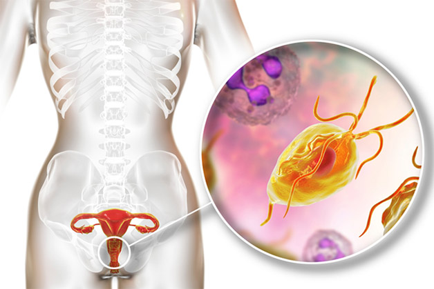 Trichomonas vaginalis là trùng roi âm đạo gây viêm, ngứa vùng kín ở phụ nữ