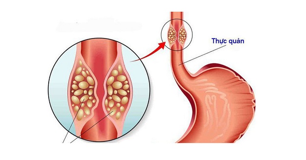 sự nguy hiểm của bệnh trào ngược dạ dày về đêm