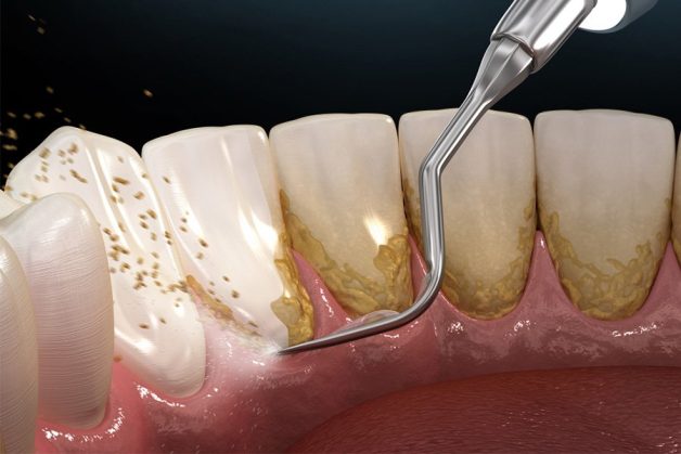 vì sao phải lấy cao răng