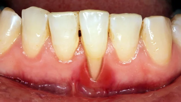 vì sao phải lấy cao răng