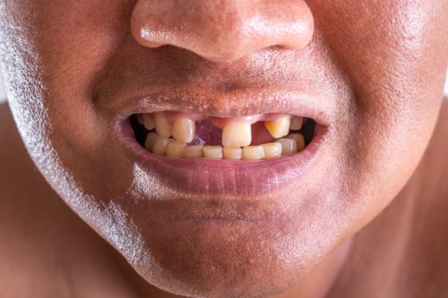 Răng lung lay và rụng là một biến chứng nguy hiểm của viêm chân răng