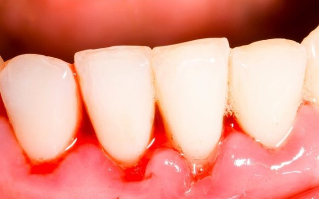 viêm lợi chảy máu chân răng