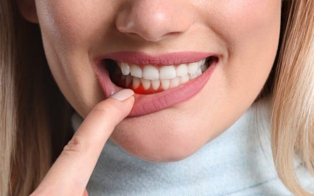 Lợi chảy máu là một dấu hiệu của viêm lợi