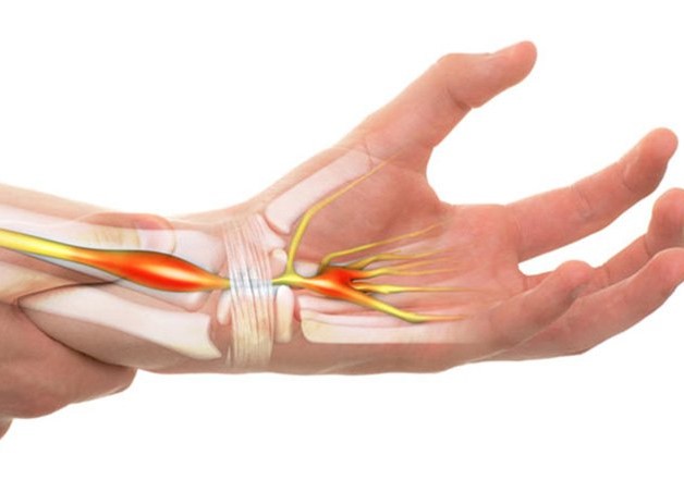 Bệnh ống cổ tay là do sự chèn ép dây thần kinh đi qua cổ tay