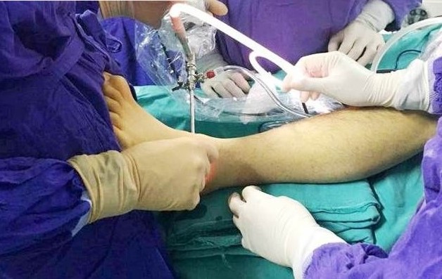 Phẫu thuật cho hội chứng ống cổ chân