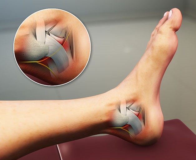 Hội chứng ống cổ chân ít phổ biến hơn so với ở cổ tay