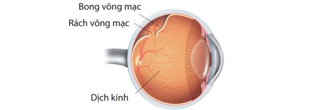 khái niệm bệnh lý bong võng mạc