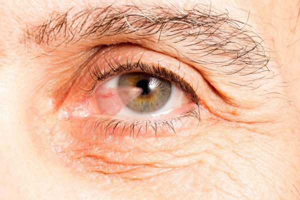 Mộng thịt về bản chất là khối u hình tam giác nhô lên ở vùng kết mạc mắt
