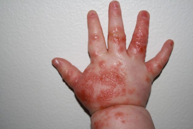 Bệnh tay chân miệng biểu hiện lâm sàng chủ yếu qua các tổn thương da và niêm mạc