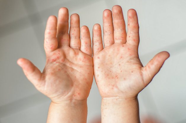Triệu chứng điển hình của tay chân miệng là những tổn thương da và niêm mạc