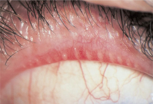 Biểu hiện viêm bờ mi mắt
