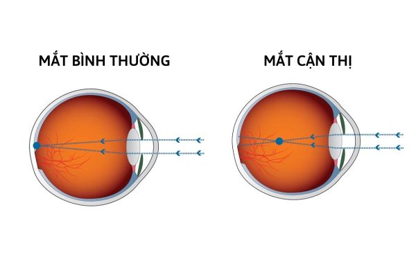 Cận thị là tình trạng ánh sáng hội tụ ở phía trước võng mạc khiến mọi người khó nhìn đồ vật ở xa