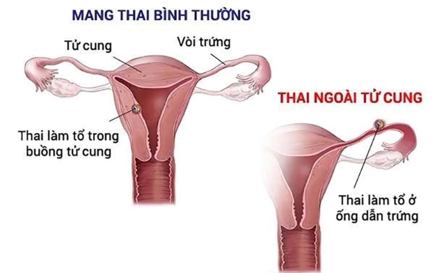 chăm sóc bệnh nhân chửa ngoài tử cung cần làm gì