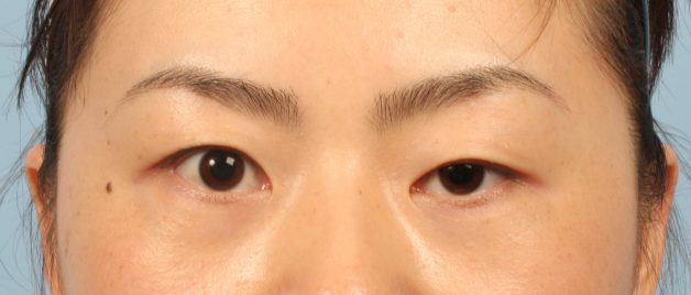 mắt bị sụp mí 1 bên ở người trưởng thành