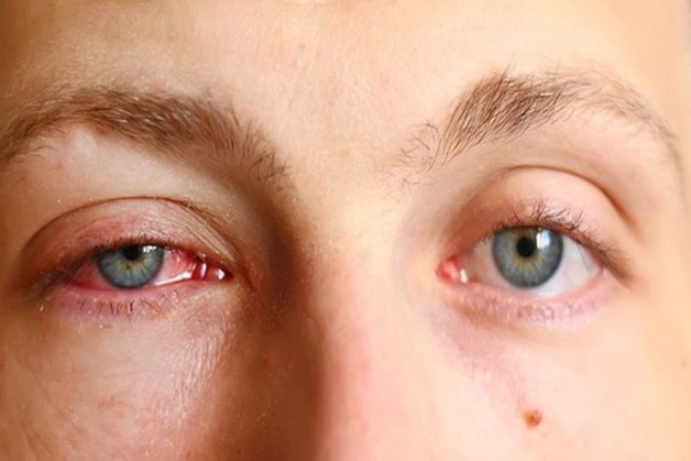 Đau mắt đỏ làm lòng trắng và mí mắt sưng đỏ
