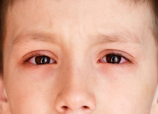 dấu hiệu đau mắt đỏ ở trẻ em
