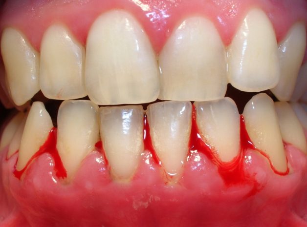 Lợi chảy máu là một dấu hiệu điển hình của viêm nướu