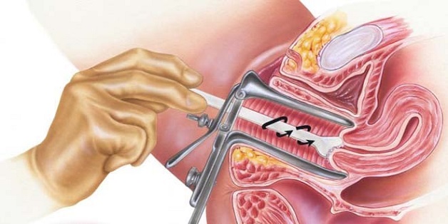 vai trò của tầm soát ung thư cổ tử cung