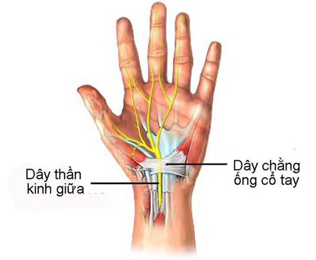 Nguyên nhân dẫn tới tê cổ tay là do hội chứng ống cổ tay