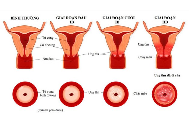 các giai đoạn của ung thư cổ tử cung