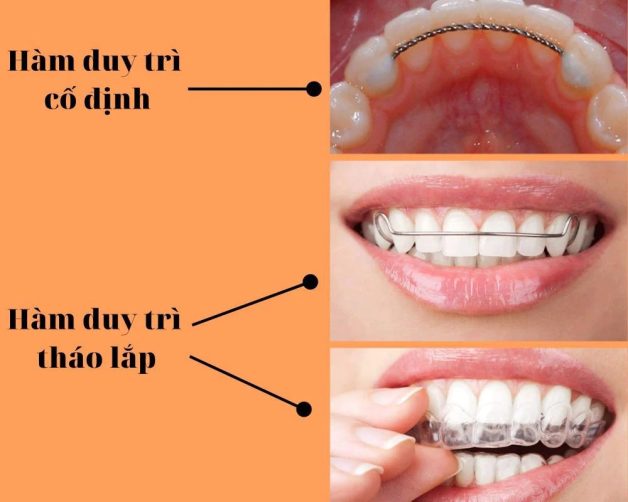 chăm sóc răng sau niềng