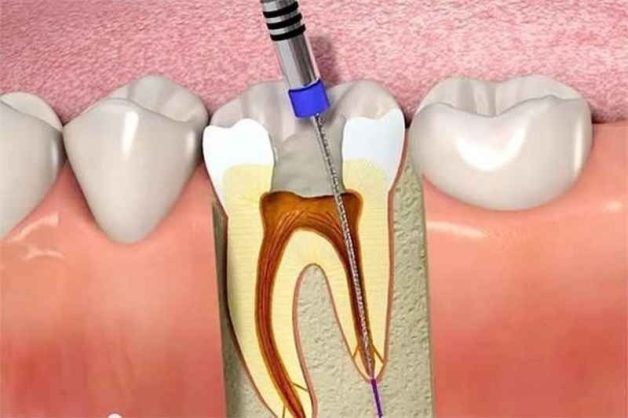 kỹ thuật điều trị tủy răng