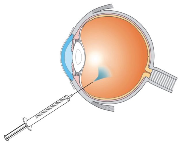 Tiêm Ocriplasmin nội nhãn điều trị lỗ hoàng điểm