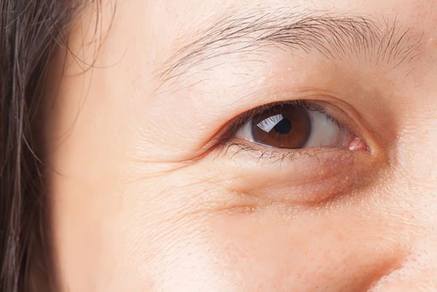 mắt bị sụp mí