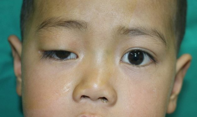 Dấu hiệu mắt bị sụp mí 1 bên