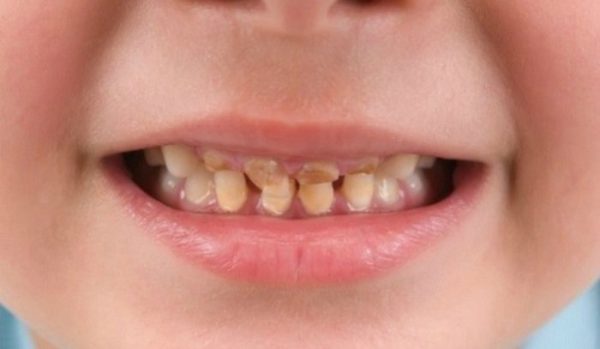 Trẻ có men răng yếu, nhanh sún là một trong những dấu hiệu trẻ đang bị thiếu canxi và có thể bị còi xương