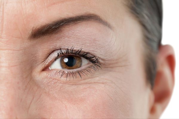 Da mí mắt chùng, rũ xuống nhãn cầu được gọi là sụp mí mắt