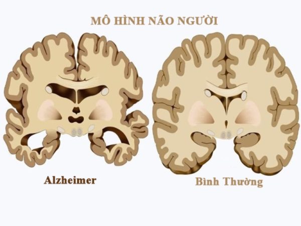 bệnh alzheimer là một nguyên nhân suy giảm trí nhớ ở người trẻ
