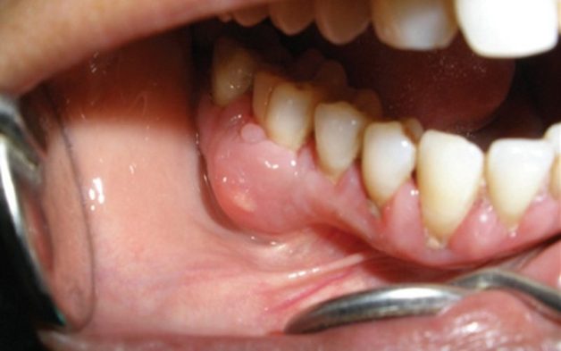 răng vĩnh viễn bị sâu
