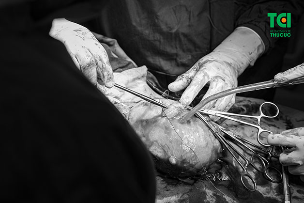 Phương pháp này là một giải pháp thay thế hoàn hảo cho phương pháp mổ mở truyền thống, hạn chế được những rủi ro