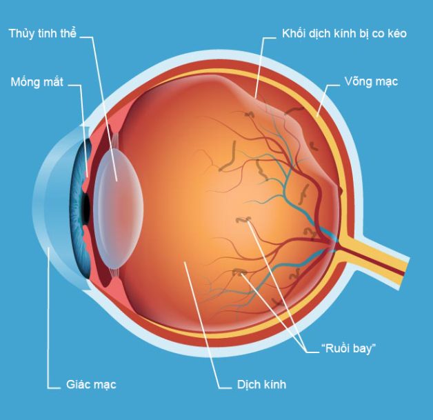 dịch kính võng mạc